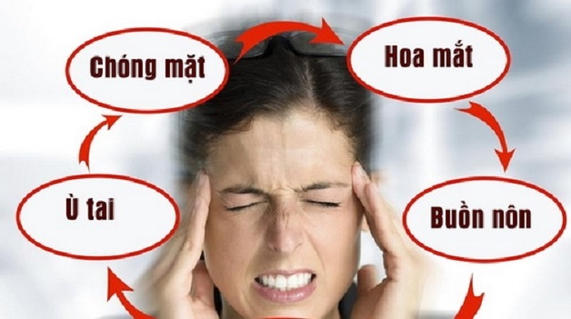 Đau nửa đầu, buồn nôn, chóng mặt có thể do bệnh tiền đình.