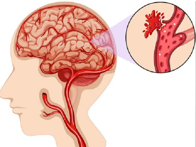 Đột quỵ xuất huyết não là hiện tượng não bị mất chức năng đột ngột do vỡ mạch máu não