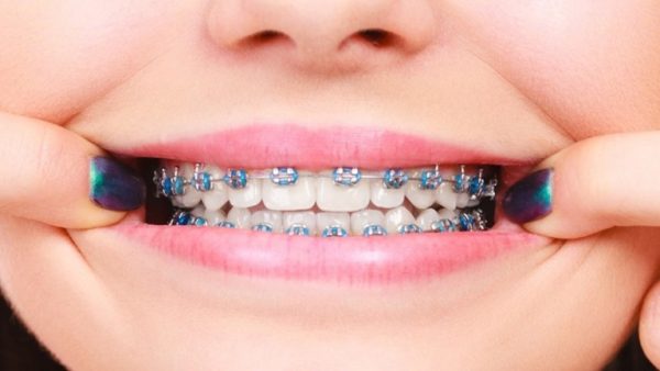 quy trình nắn chỉnh răng bằng mắc cài