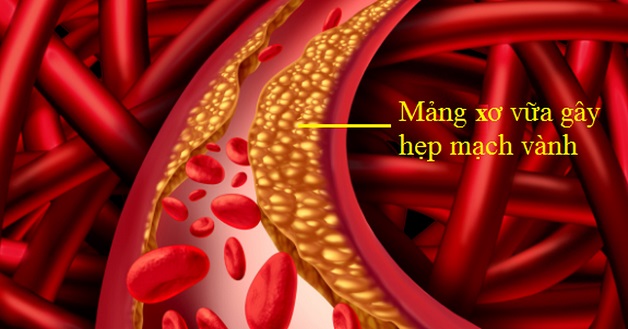 Bệnh hẹp mạch vành gây ra bởi các mảng xơ vữa nếu không được điều trị kịp thời thì có thể dẫn tới nhiều biến cố tim mạch, trong đó có nhồi máu cơ tim.