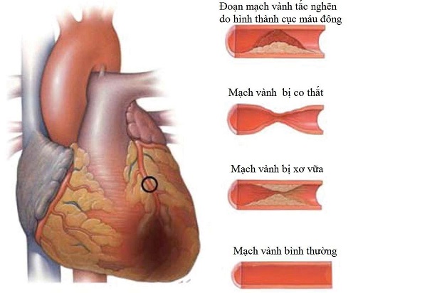 Hở van tim 1/4 do các bệnh lý tim mạch gây ra rất nguy hiểm