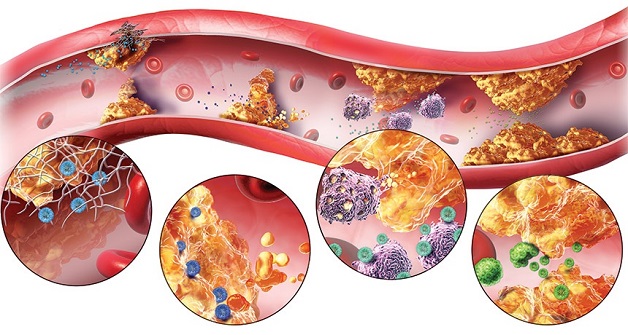 Rối loạn lipid là nguyên nhân hàng đầu gây xơ vữa động mạch vành
