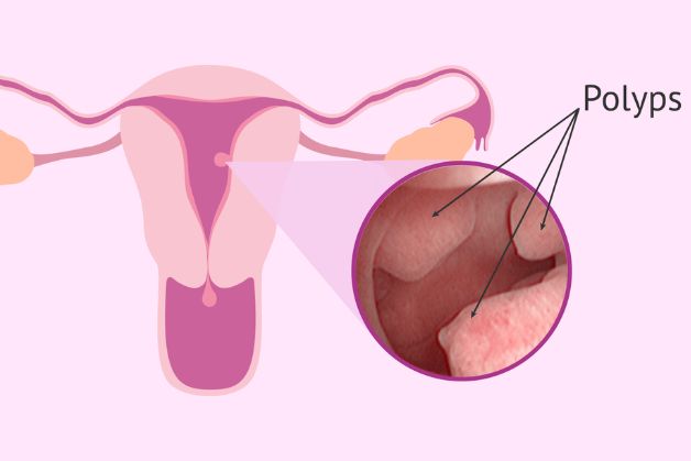 Phẫu thuật cắt polyp tử cung và những điều cần biết