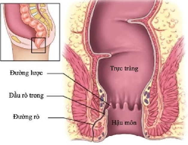 Rò hậu môn là một bệnh lý tiêu hóa phổ biến