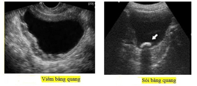 Hình ảnh viên sỏi khi được quan sát bằng siêu âm sỏi bàng quang