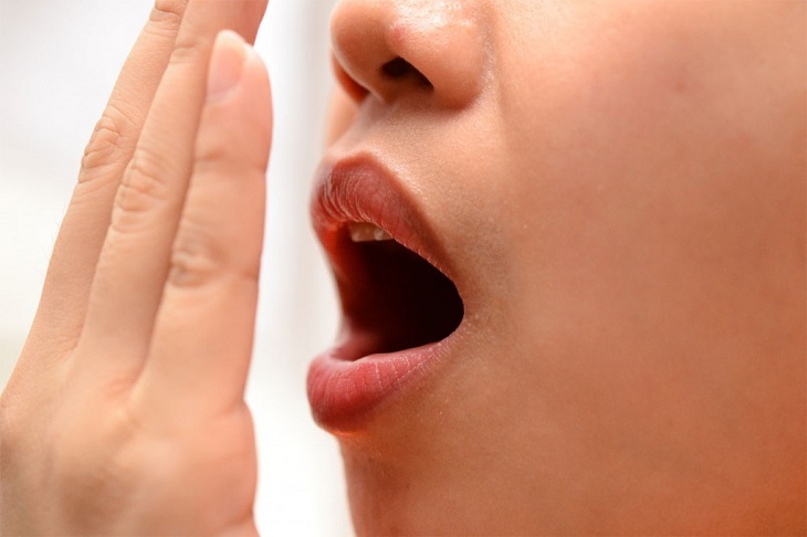 Sỏi amidan gây hôi miệng