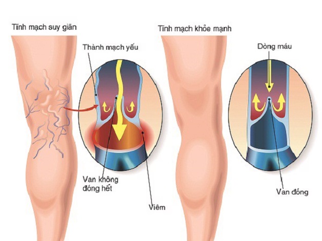 Suy giãn tĩnh mạch chi dưới là sự suy giảm chức năng của hệ thống tĩnh mạch nằm ở vùng chân