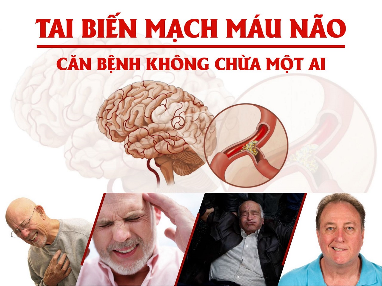 Minh họa nguyên nhân tai biến mạch máu não do tắc nghẽn mạch máu và xơ vữa động mạch