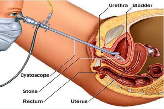 Tán sỏi có đau không theo lý giải của các bác sĩ và chuyên gia. 