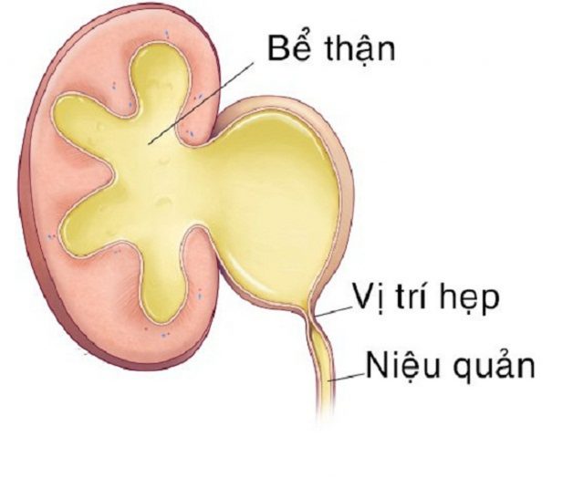 Tìm hiểu về phương pháp tạo hình bể thận. 