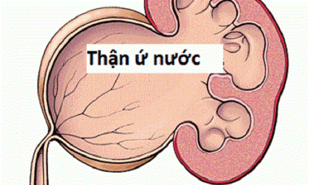 Tạo hình bể thận được chỉ định khi thận ứ nước, ứ mủ do chít hẹp khúc nối bể thận - niệu quản