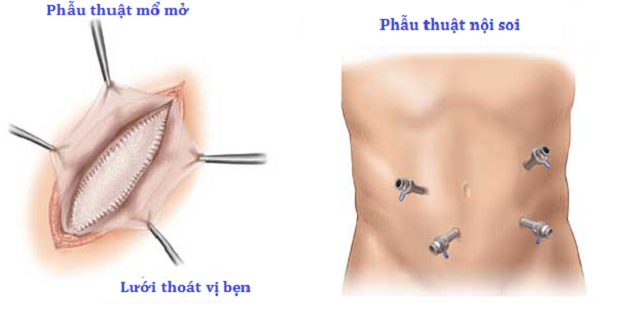 Phẫu thuật mổ nội soi điều trị thoát vị bẹn ở trẻ có nhiều ưu điểm vượt trội