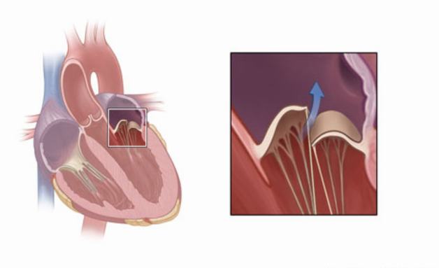 Bệnh nhân ở van tim sống được bao lâu còn phụ thuộc vào mức độ và loại hở van tim