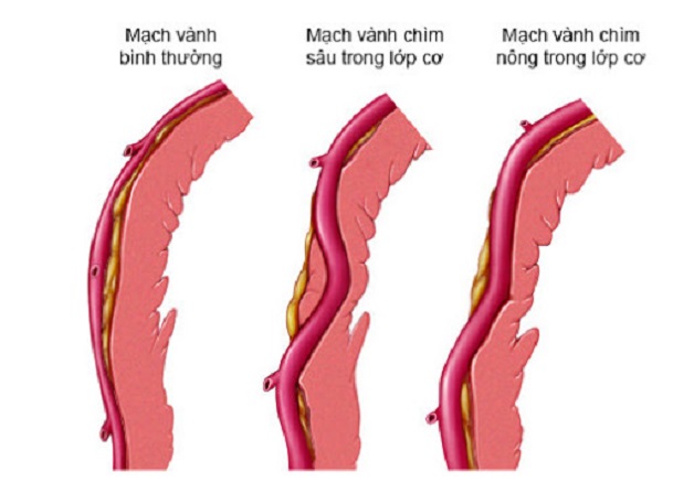 Hình ảnh cầu cơ động mạch vành