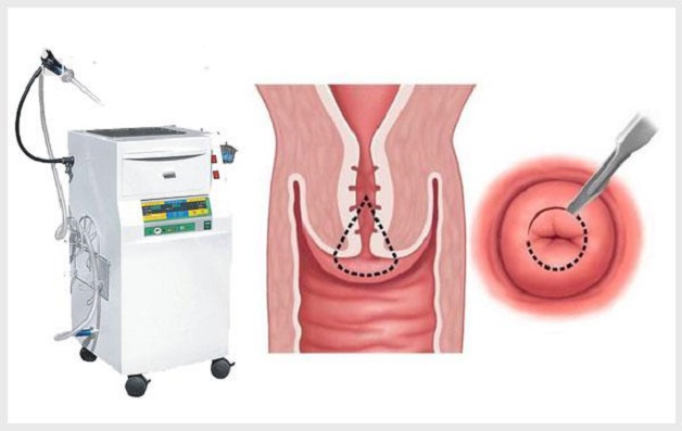 Dao Leep là một trong phương pháp điều trị viêm cổ tử cung hiệu quả