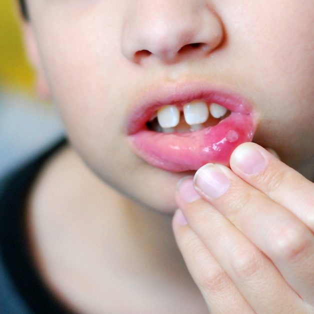 bệnh viêm loét niêm mạc miệng ở trẻ em