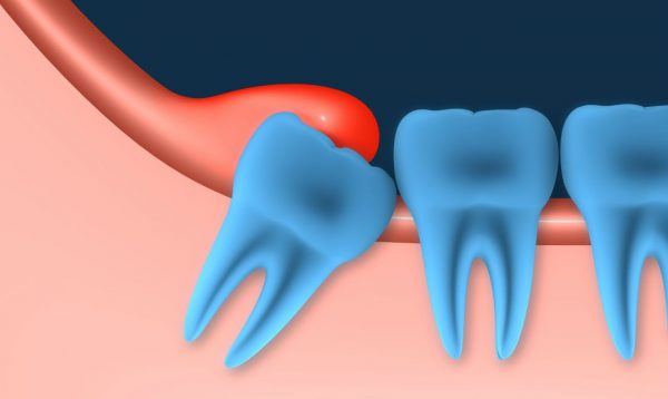 phương pháp điều trị viêm lợi trùm