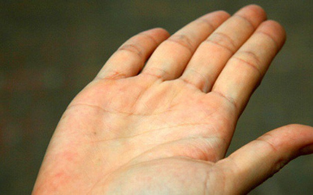 Vàng da là một trong những dấu hiệu bạn cần giảm men gan