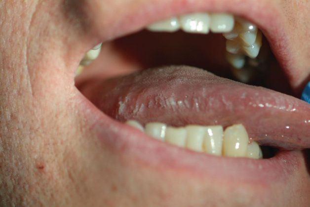 Với bạch sản dạng lông, triệu chứng thường gặp là lông xuất hiện, có những mảng trắng mờ dạng nếp gấp hoặc đường lằn ở hai bên đầu lưỡi