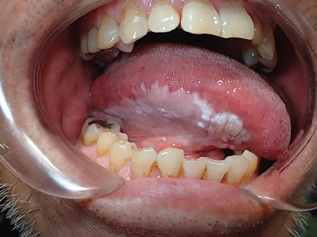 bệnh bạch sản niêm mạc miệng
