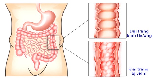 triệu chứng bệnh đường tiêu hóa là gì