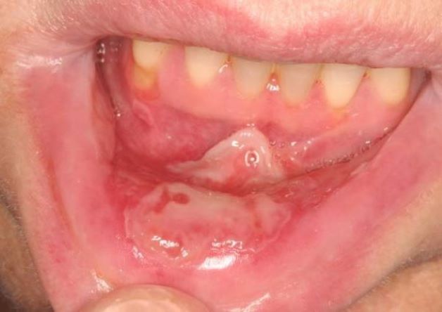 Loét niêm mạc miệng đều có đặc điểm chung là có màu đỏ xung quanh, trung tâm có mảng màu vàng, gây cảm giác đau đớn trong 2 – 3 ngày đầu