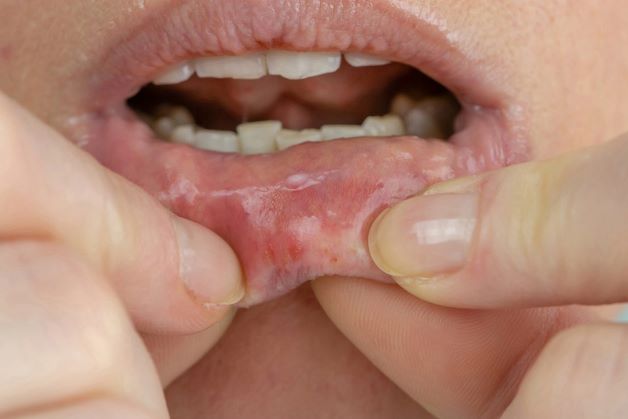 Viêm loét niêm mạc miệng sẽ khiến người bệnh bị hôi miệng, gây đau đớn và khó khăn cho người bệnh khi ăn uống và sinh hoạt.