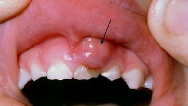 Nguyên nhân phổ biến gây ra viêm lợi trẻ em là sự tích tụ của các mảng bám ở răng