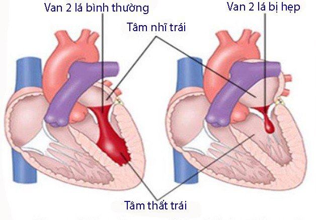 Hẹp van tim hai lá khiến máu ứ đọng ở nhĩ trái và phổi, gây khó thở, suy tim phải.