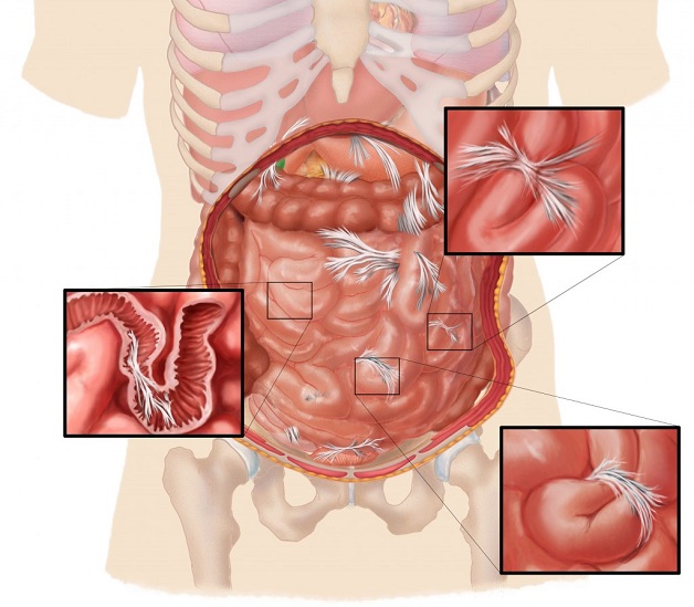 Có nhiều nguyên nhân dẫn đến bị tắc ruột