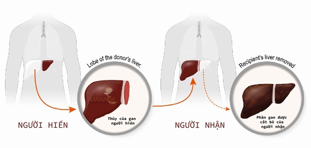xơ gan mất bù