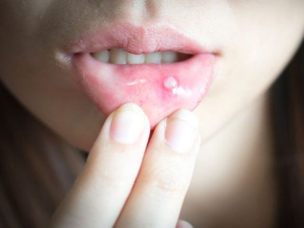 cách trị nhiệt miệng tại nhà đơn giản