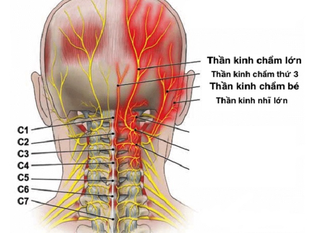 bệnh đau đầu arnold là gì?