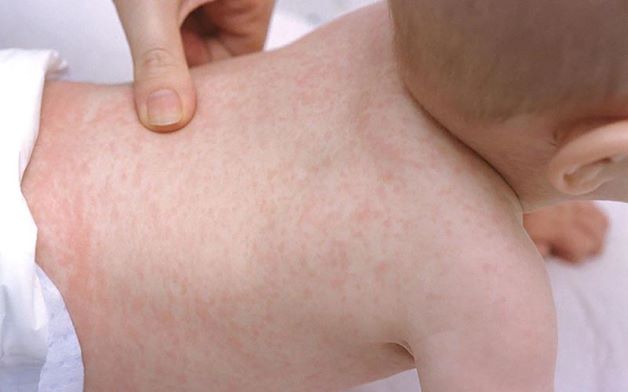 Phát ban là dấu hiệu cho thấy sốt của trẻ sẽ thuyên giảm bởi  lúc này bệnh đã qua thời kỳ ủ bệnh và phát bệnh. 