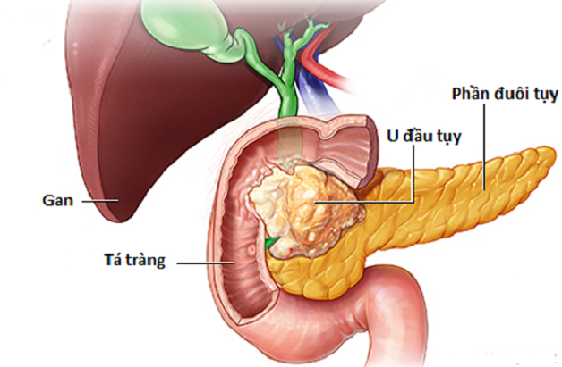 đi tìm câu trả lời Ung thư tụy có nguy hiểm không
