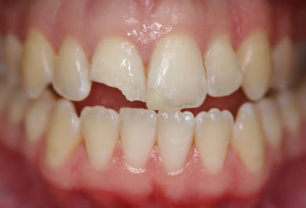 Với các trường hợp răng bị sứt, mẻ ở mức độ nhẹ có thể dùng các biện pháp phục hồi như hàn trám để khắc phục.