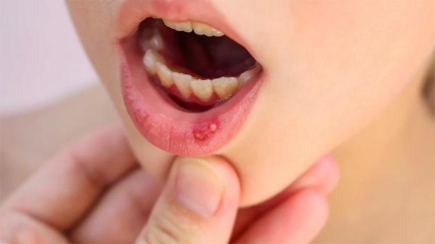 khắc phục tình trạng bị nhiệt miệng