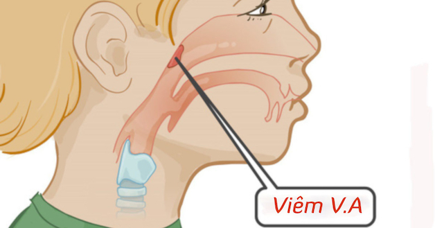 nạo VA cho trẻ như thế nào