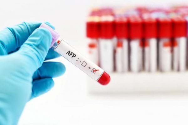 Chỉ xét nghiệm AFP có phát hiện được ung thư gan không?