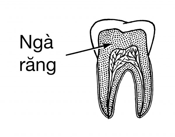 ngà răng lộ ra khiến răng bị nhạy cảm