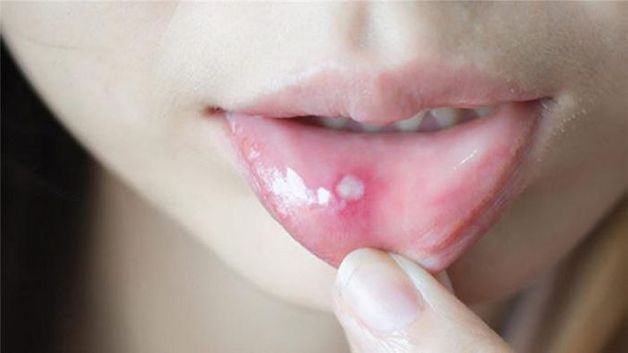 dấu hiệu nhiệt miệng dưới lưỡi