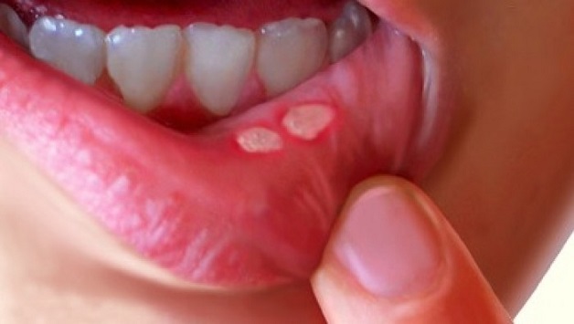 Hình ảnh của vết loét do nhiệt miệng