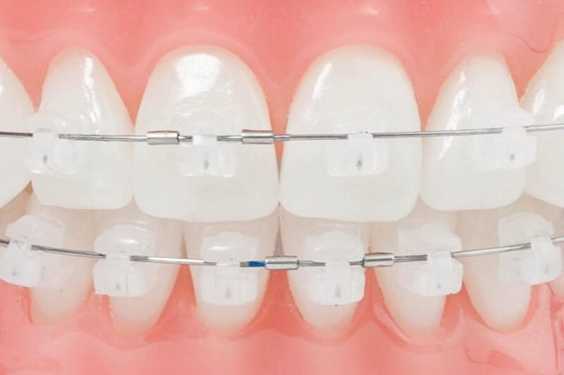 Thay vì dùng vật liệu kim loại, nha khoa hiện đại đã cải tiến và sử dụng sứ - vật liệu có màu tự nhiên và gần tương đồng với màu răng