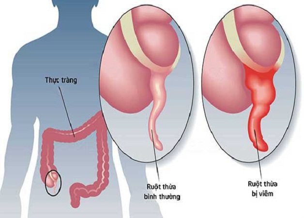 Phẫu thuật cắt ruột thừa bị viêm để ngăn chặn các biến chứng nguy hiểm xảy ra