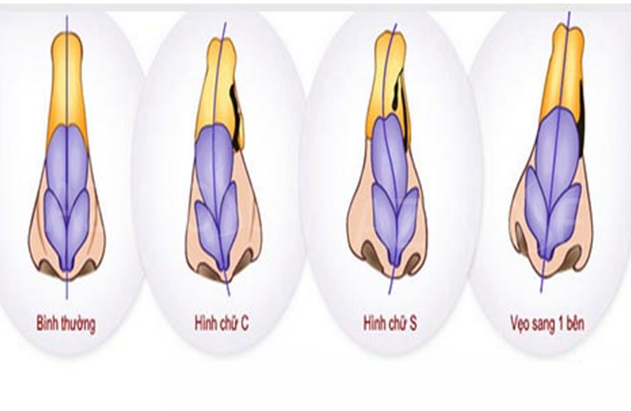 Mũi bình thường và mũi bị lệch vách ngăn