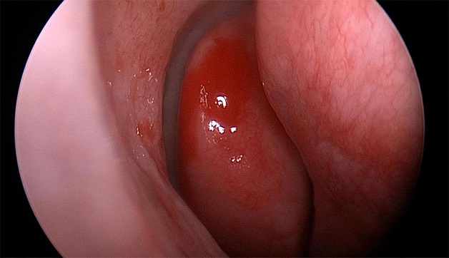 Niêm mạc mũi bị sưng đỏ, kéo dài là nguyên nhân hình thành polyp mũi.