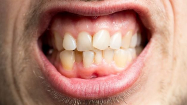 Răng mọc không đều là nguyên nhân gây nên bạch sản niêm mạc miệng