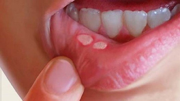 Rất nhiều người gặp phải bệnh viêm loét niêm mạc miệng