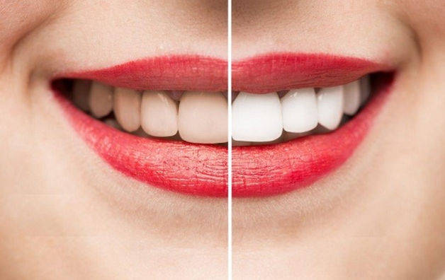 Tẩy trắng răng là phương pháp phổ biến, giúp cải thiện vẻ đẹp của hàm răng.