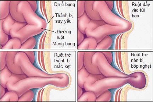 Thoát vị bẹn nghẹt khiến các tạng không thể si chuyển trở lại ổ phúc mạc